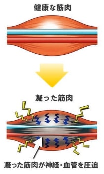 血管が圧迫された図、宇治市の田中治療院の深層筋治療で解消していただきたい
