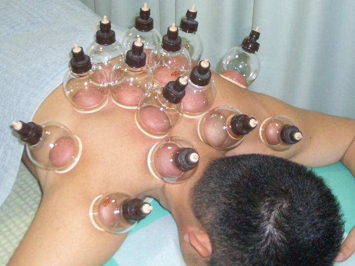 田中治療院 肩のカッピング