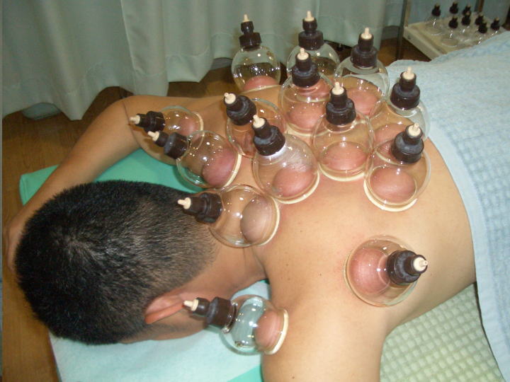 田中治療院 カッピングによるデトックス効果