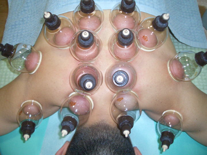 田中治療院 カッピングによるデトックス効果