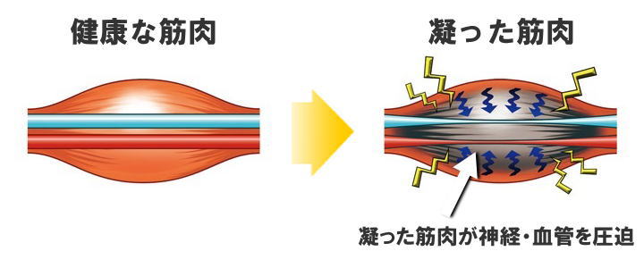 血管が圧迫された図、宇治市の田中治療院の深層筋治療で解消していただきたい
