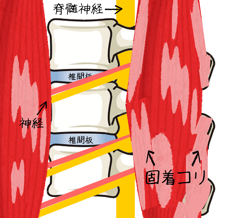 固着コリを点と面のアプローチで根本から改善する深層筋治療の図解